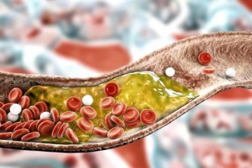 Novo remdio aprovado pela Anvisa pode controlar o colesterol com apenas duas aplicaes por ano
